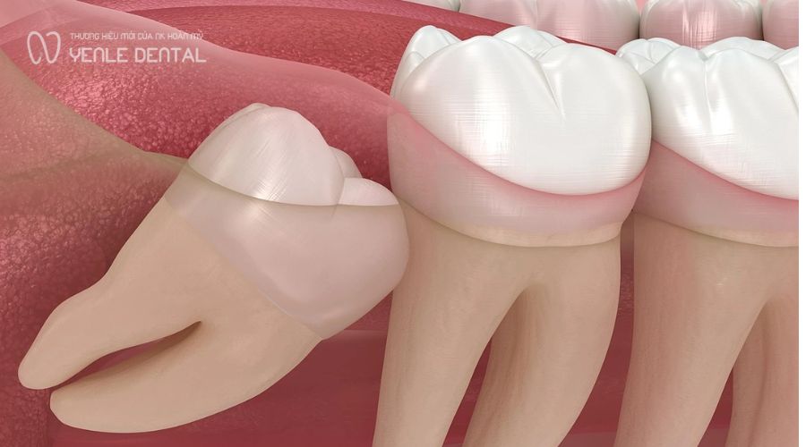 khi nào nên nhổ răng khôn